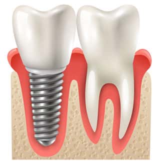 Dental Implants in Ann Arbor and Ypsilanti (Ypsi), Washtenaw, Michigan by Dental House