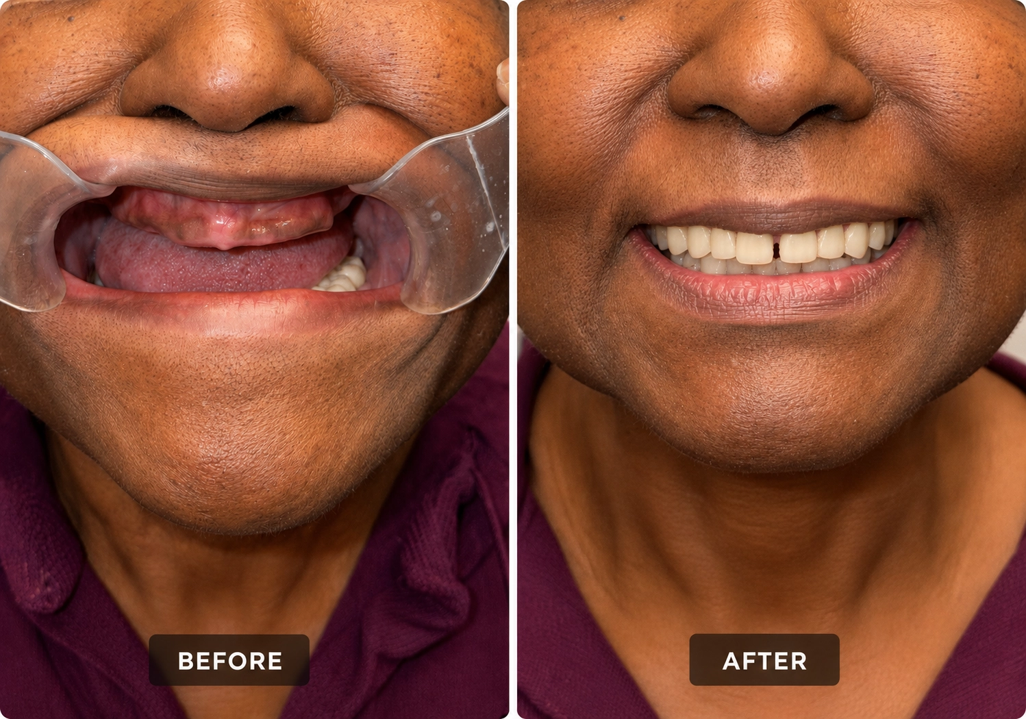 Before and after denture transformation