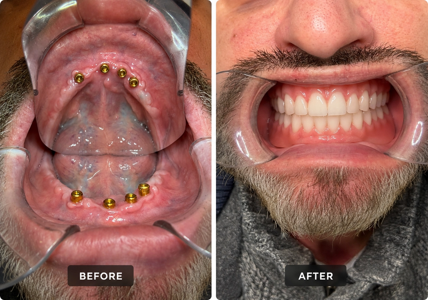 Before and after denture transformation